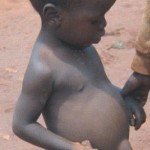 Vote ZANU-PF or Starve This child, diagnosed as having kwashiorkor, is from an MDC supporting family that allegedly has been consistently denied access to food on political grounds.