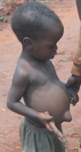 This child, diagnosed as having kwashiorkor, is from an MDC supporting family that allegedly has been consistently denied access to food on political grounds. 